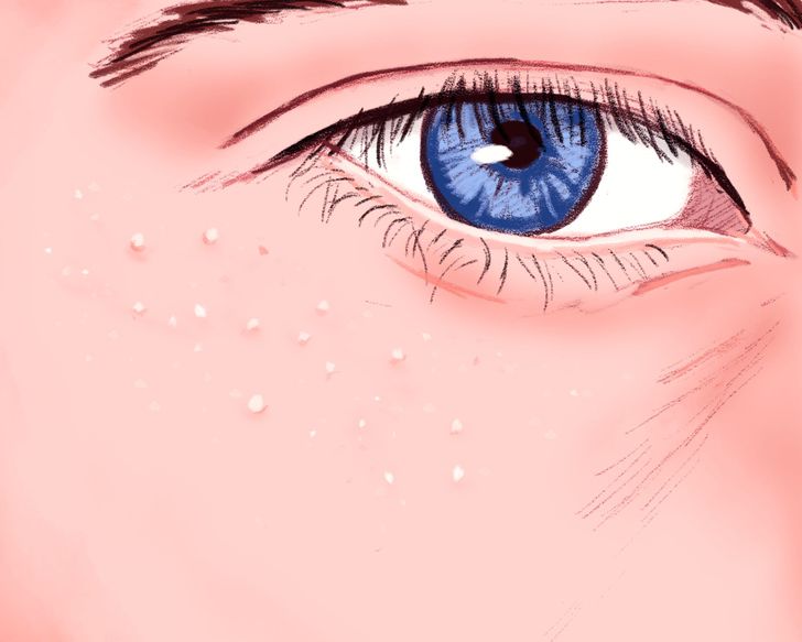 What Are Those White Pimples That Appear Around Your Eyes