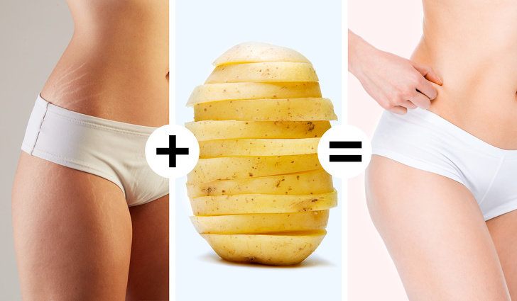 Potatoes to treat stretch marks