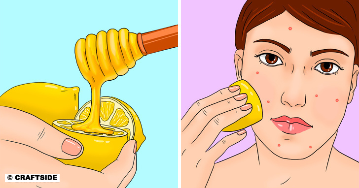 Lemon with honey to treat acne