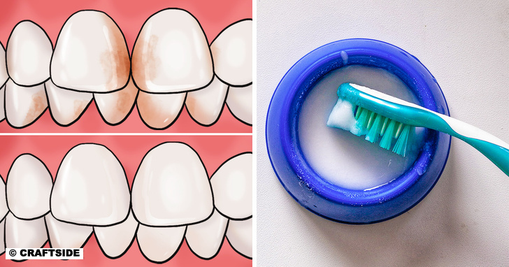 10 Home Remedies to Remove Tartar Stains From Your Teeth