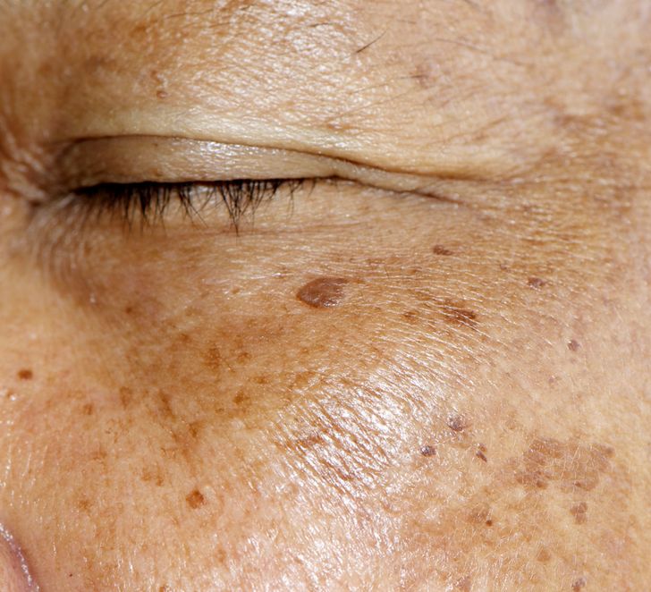 What Causes Skin Pigmentation, and 3 Ways to Avoid It