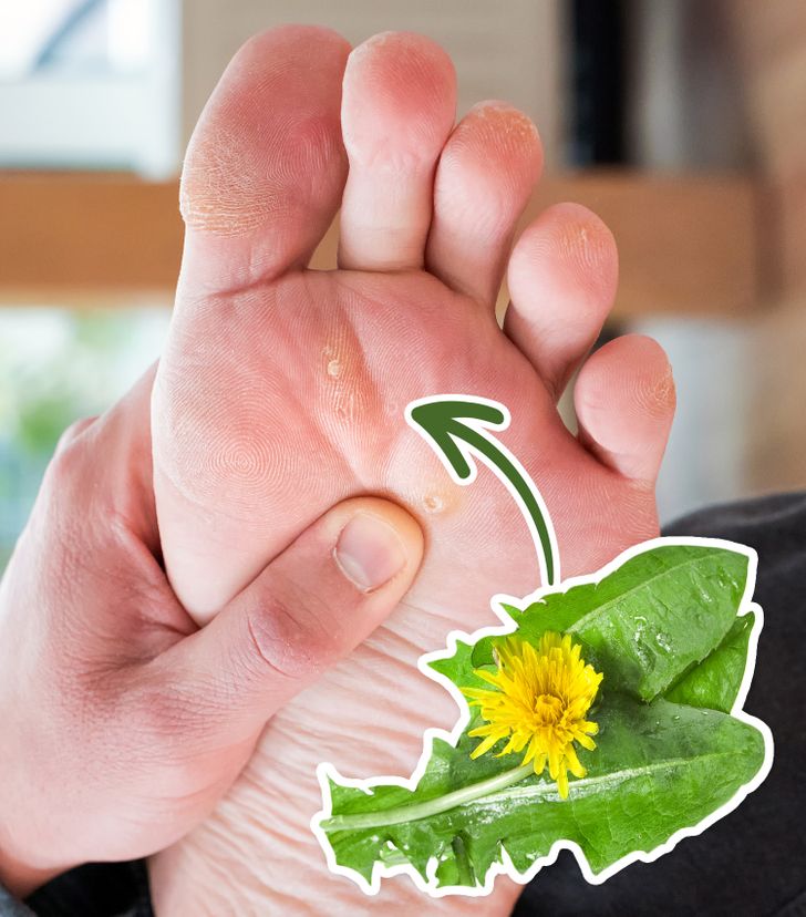 6 Home Remedies To Get Rid Of Warts Naturally You Can Try Today