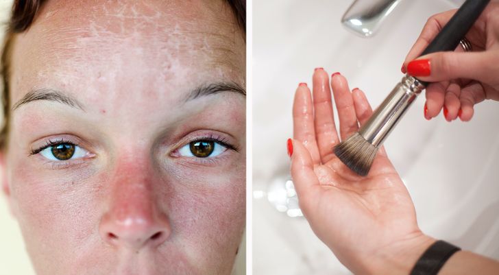 6 Things You Shouldn’t Do After Getting a Sunburn