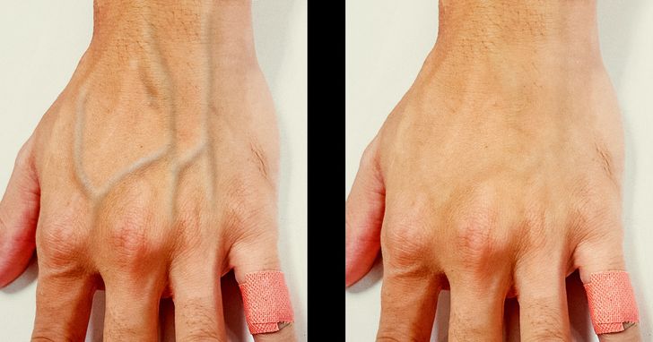 Why Do Some People’s Veins Appear Through Their Skin?