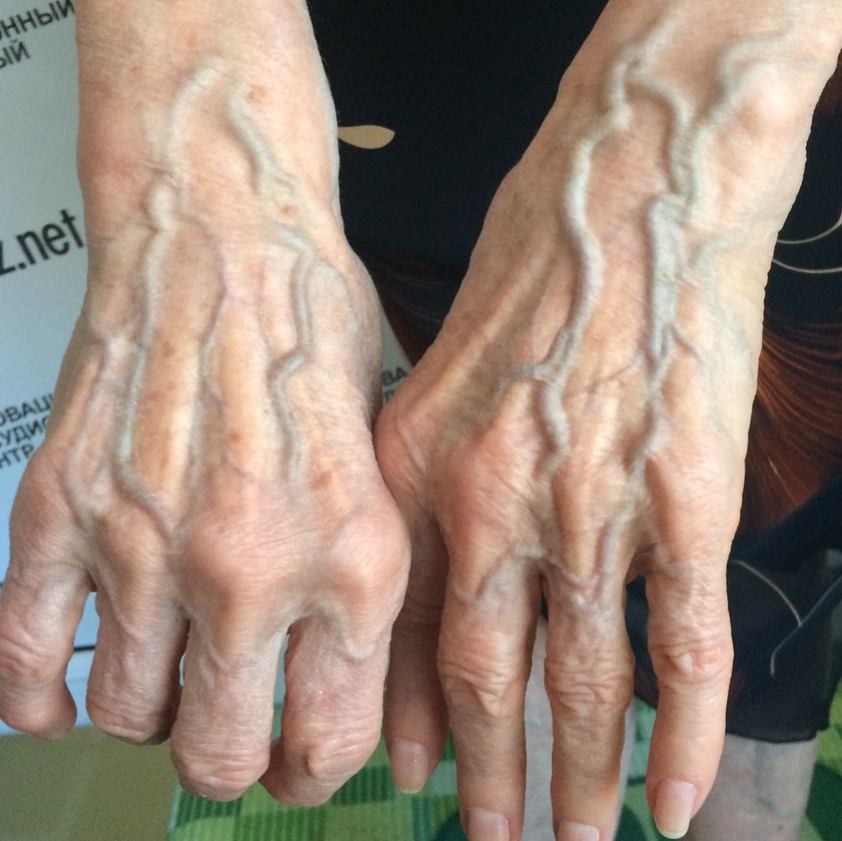 Why Do Some People’s Veins Appear Through Their Skin?